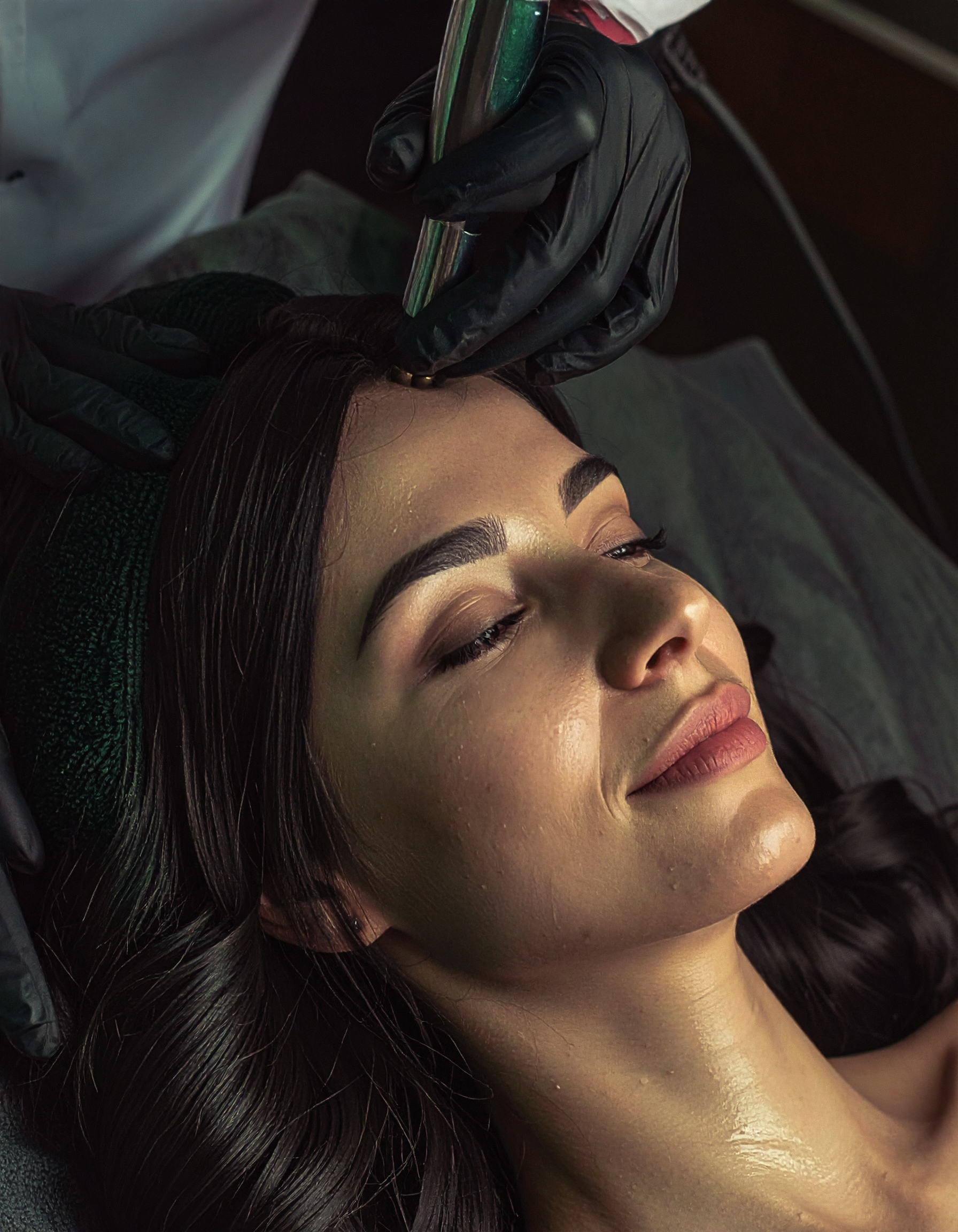 Microneedling